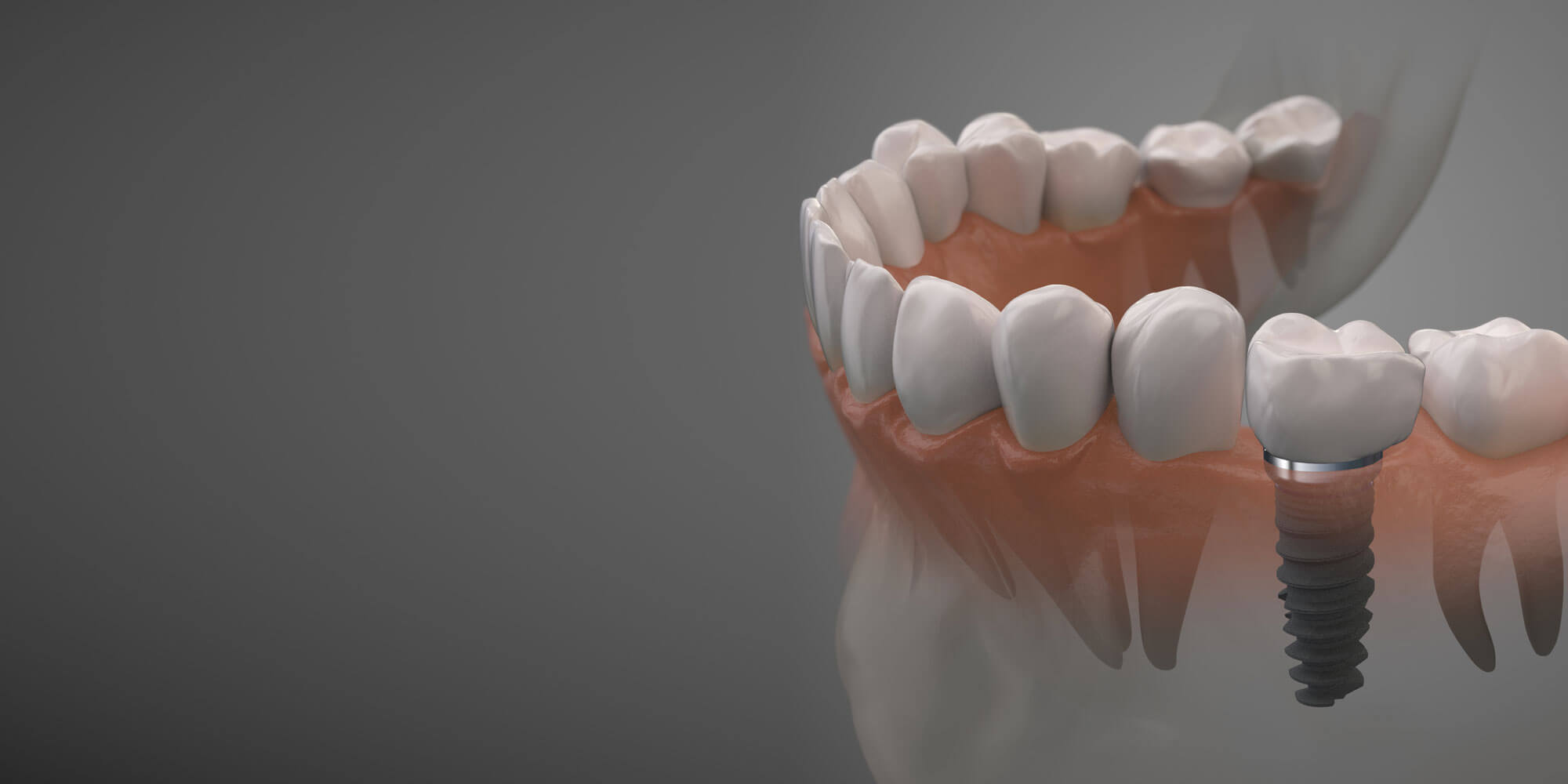 dental implants and veneers-01